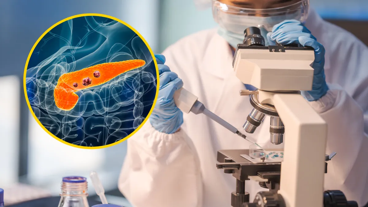 Przełom w leczeniu. Skuteczny lek na raka trzustki niebawem trafi do obrotu w USA